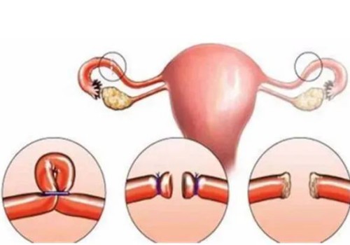 寧波供卵試管：子宮腺肌癥可以通過中醫(yī)治療，這些緩解子宮腺肌癥方法也不要忽略