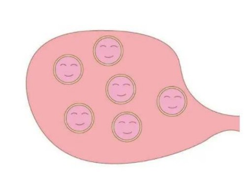 寧波試管嬰兒價格：怎樣解決子宮肌瘤帶來的困擾？