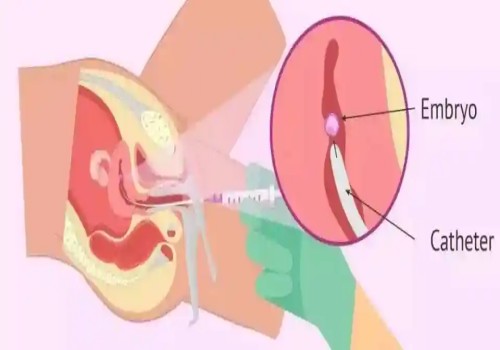 偶發(fā)還是遺傳？看看4號(hào)染色體三體異?，F(xiàn)象的真正原因