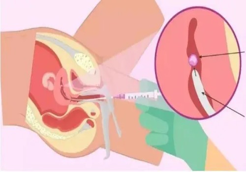 寧波三代試管助孕：產(chǎn)婦坐月子是42天還是30天？到底哪一個(gè)正確