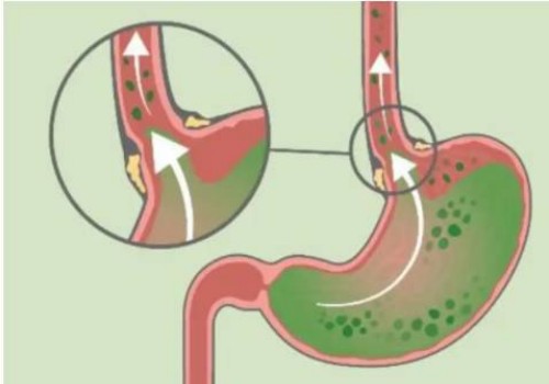 寧波供卵試管：做試管需要對(duì)精子怎么處理，需要預(yù)洗嗎